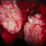 Ukraine mystery H1N1 flu destroying the lungs