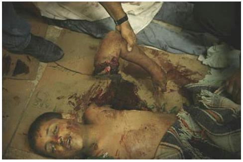 Palestinian child with severed arm