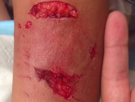 The wound inflicted by the dog who attacked the small boy (YouTube)